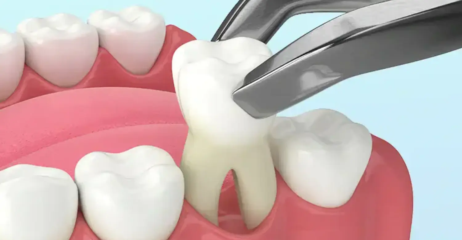 Pull Teeth Same Day 2
